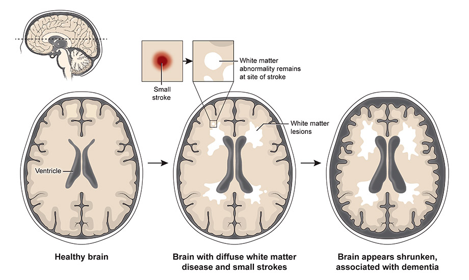 Graphic illustration of a brain MRI showing a healthy brain, the brain with diffuse white matter disease and small strokes and the brain shrunken, which is associated with dementia. 